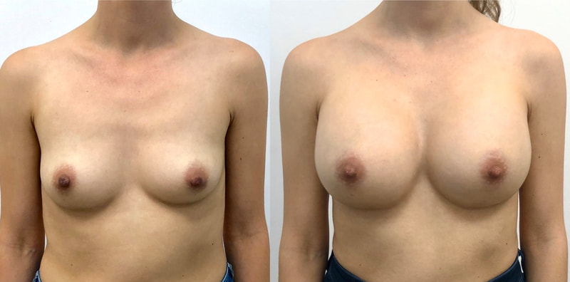 Breast implant before & after 102