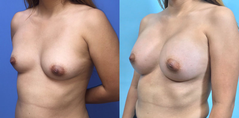 Breast implant before & after 103