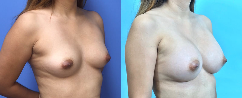 Breast implant before & after 104