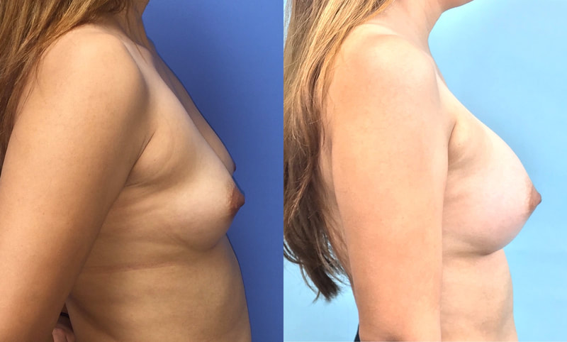 Breast implant before & after 105