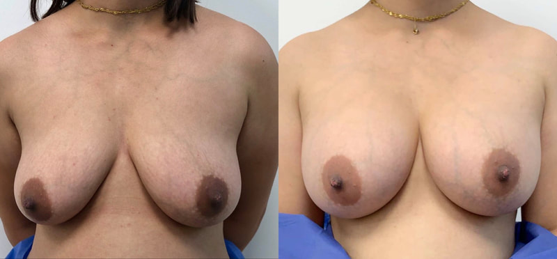 Breast implant before & after 38