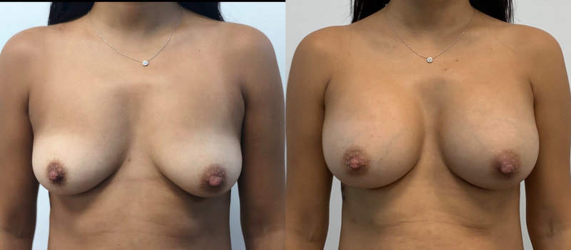 Breast implant before & after 39