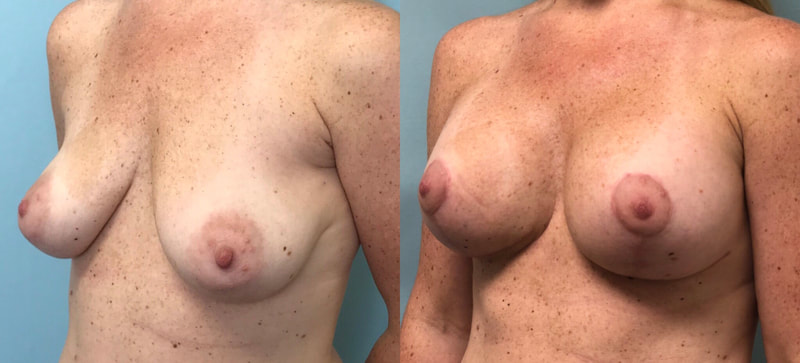 Breast implant before & after 40
