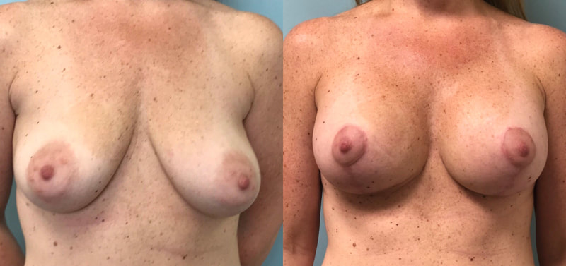 Breast implant before & after 41