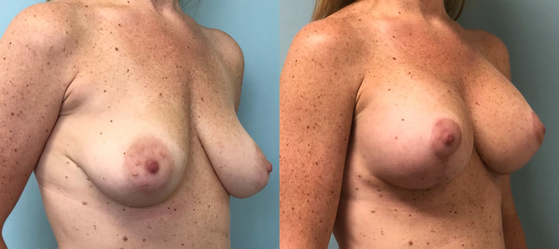 Breast implant before & after 42