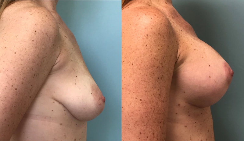Breast implant before & after 43