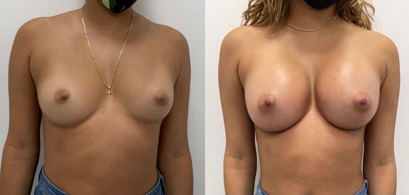 Breast implant before & after 119