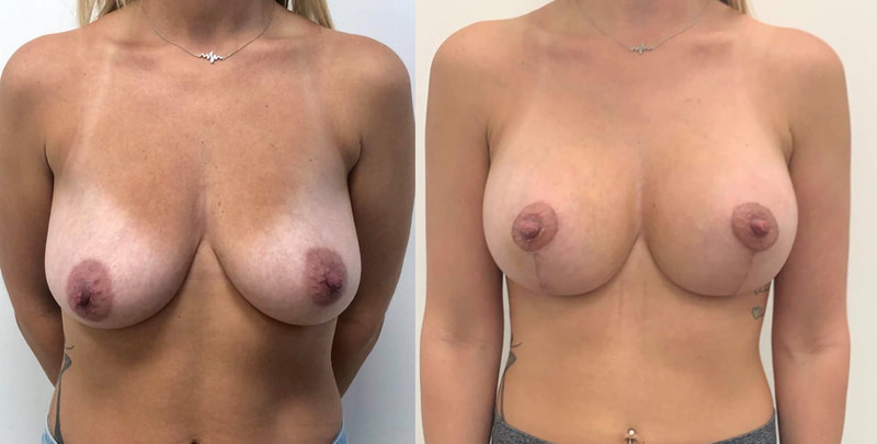 Breast implant before & after 41