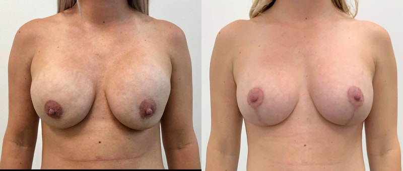 Breast implant before & after 43