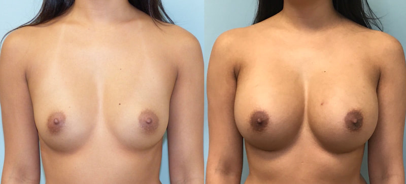 Breast implant before & after 46