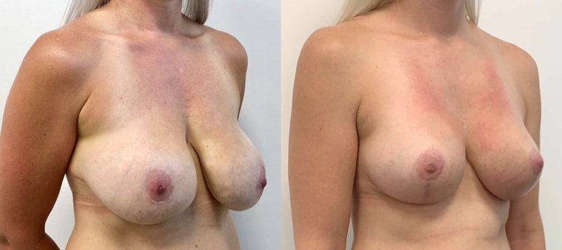 Breast implant before & after 47