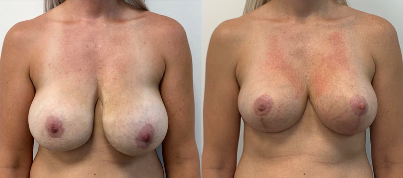 Breast implant before & after 48