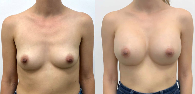 Breast implant before & after 400