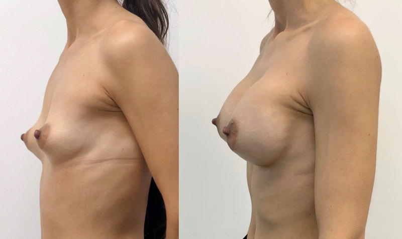 Breast implant before & after 401