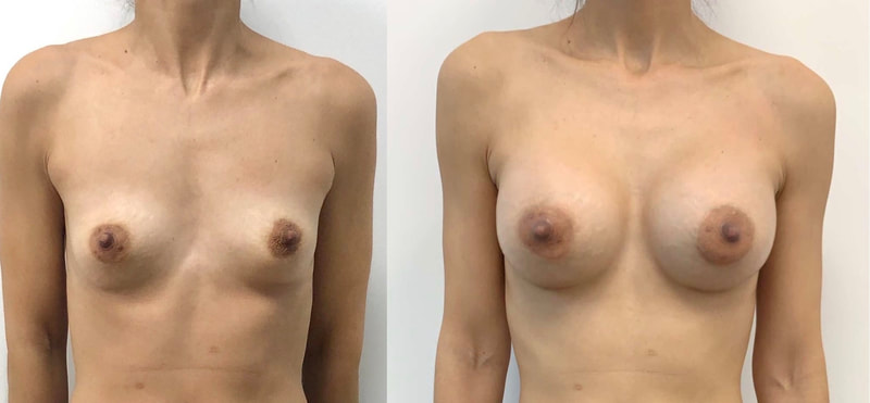 Breast implant before & after 402