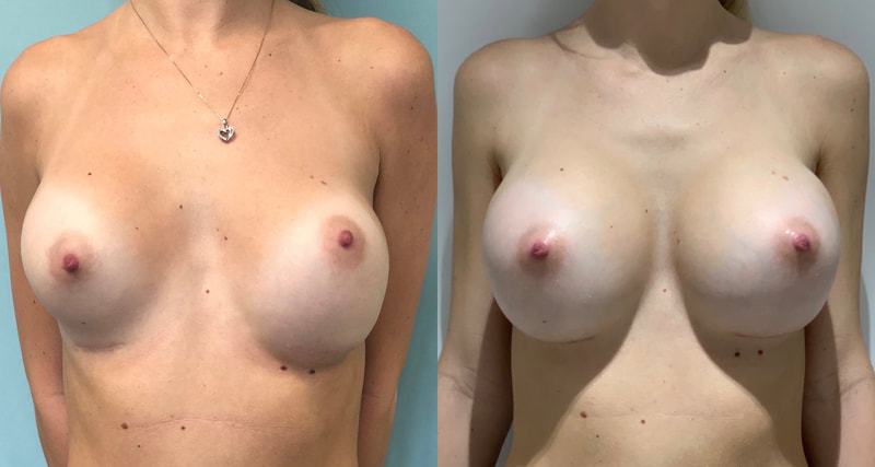 Breast implant before & after 49