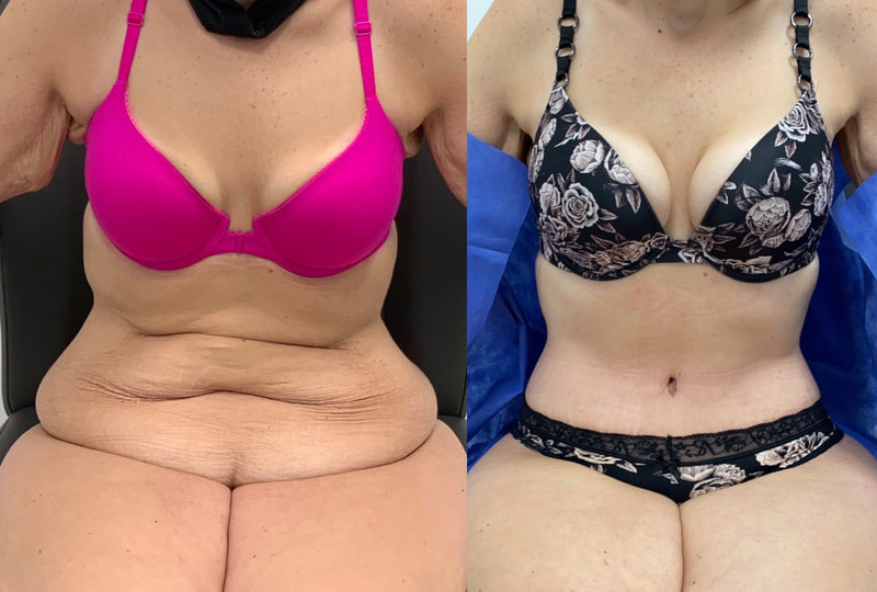 tummy tuck  - before & after 100