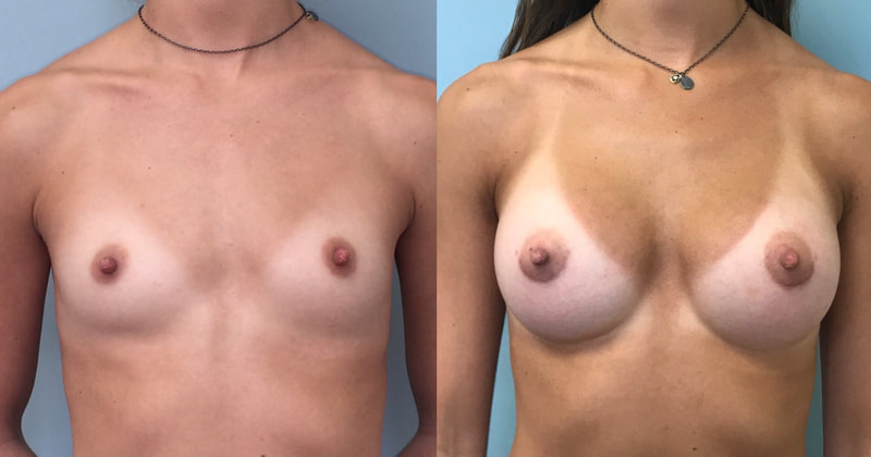 Breast implant before & after 52