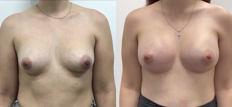 Breast implant before & after 53