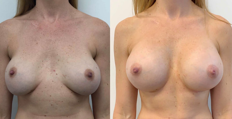 Breast implant before & after 106