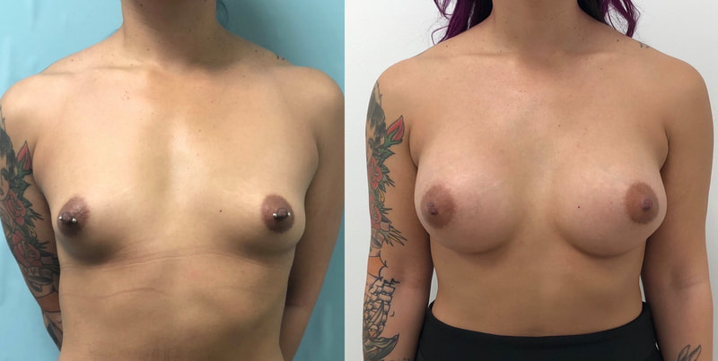 Breast implant before & after 54