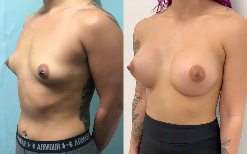 Breast implant before & after 55