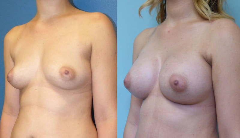 Breast implant before & after 56