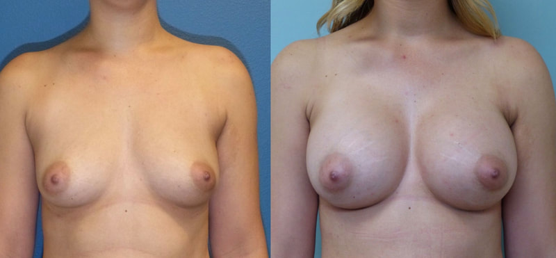 Breast implant before & after 57