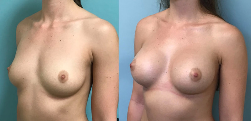 Breast implant before & after 58