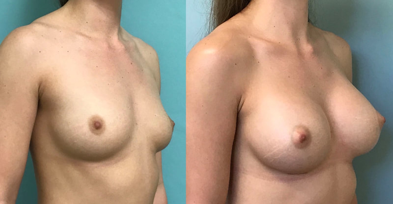 Breast implant before & after 59