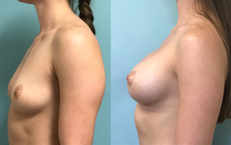 Breast implant before & after 60
