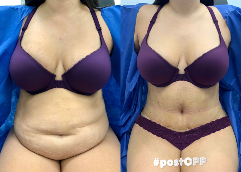 tummy tuck  - before & after 89