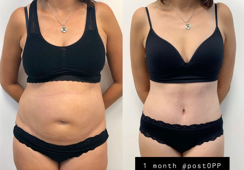 tummy tuck  - before & after 90