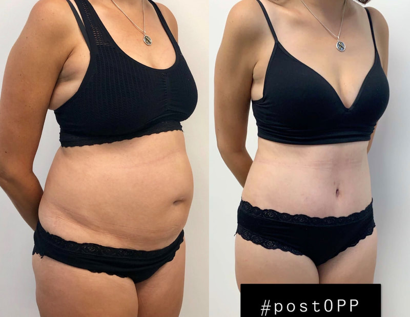 tummy tuck  - before & after 91