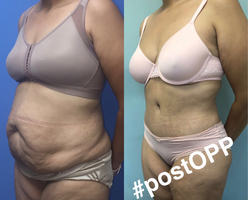 tummy tuck  - before & after 92