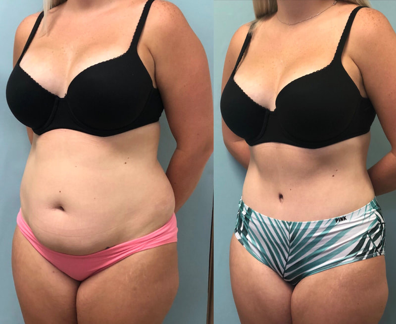 tummy tuck  - before & after 93
