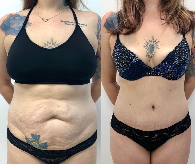 tummy tuck  - before & after 94