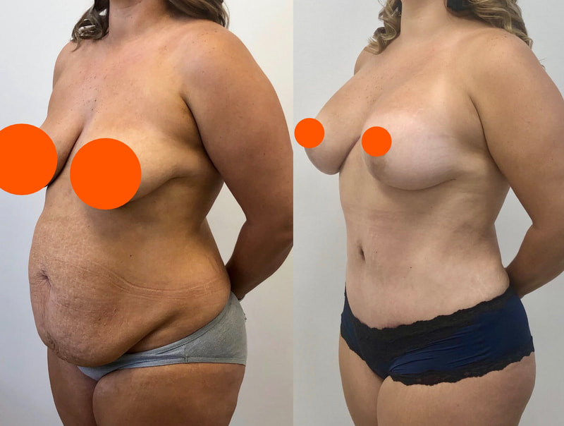 tummy tuck  - before & after 95