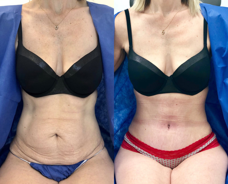 tummy tuck  - before & after 96