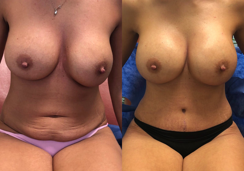 tummy tuck  - before & after 97