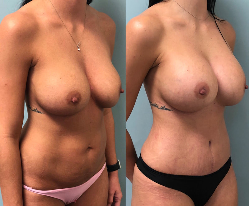 tummy tuck  - before & after 98