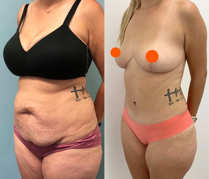 tummy tuck  - before & after 99