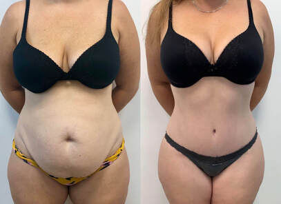 Not Sure What a Tummy Tuck Can Do for You? Here Are Your 3 Best