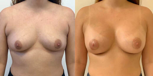 before and after breast implants