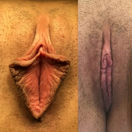 Inner labia with folds before and after labiaplasty
