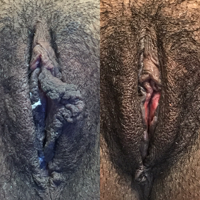 Large labia with hygiene issues 