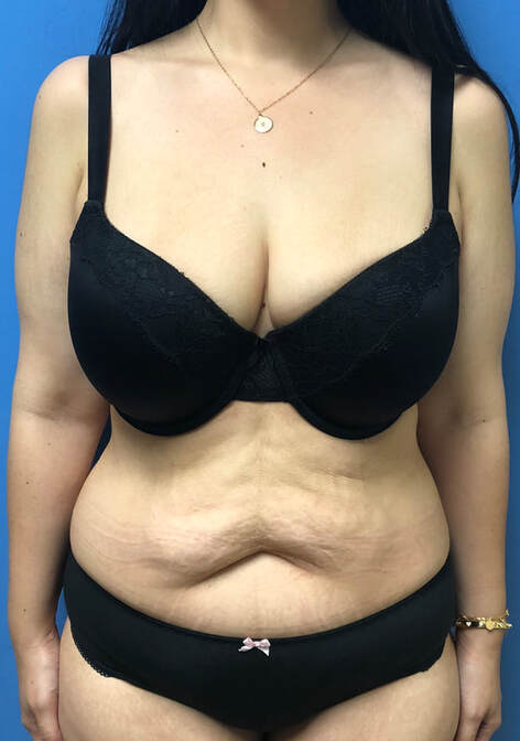 Tummy Tuck (3 Month Post op) Update!! Before and After In Pictures