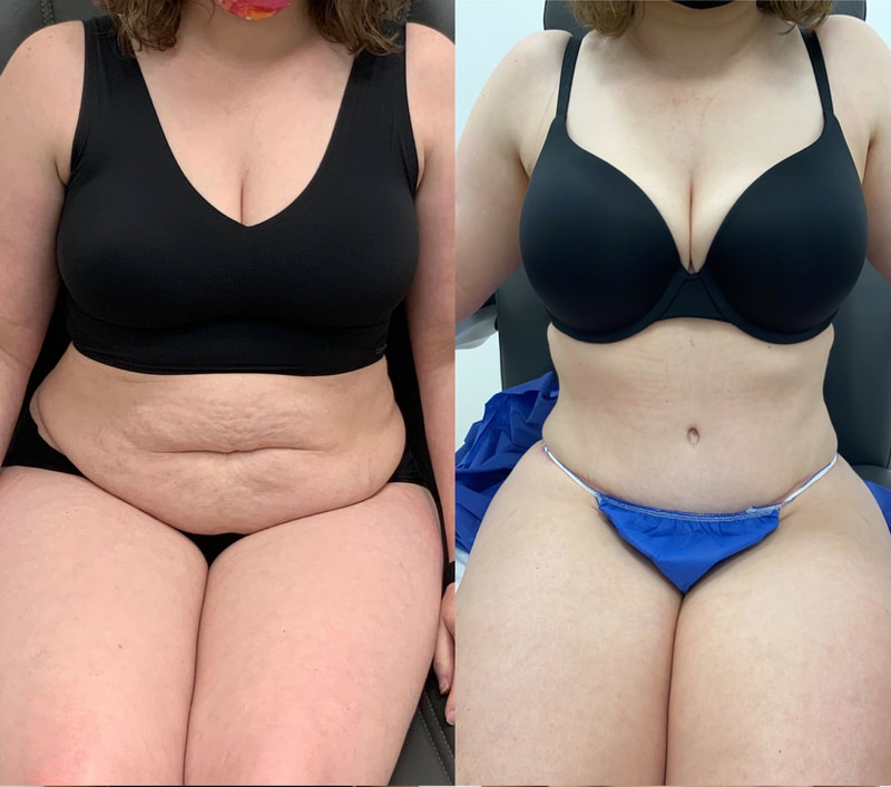 tummy tuck  - before & after 112