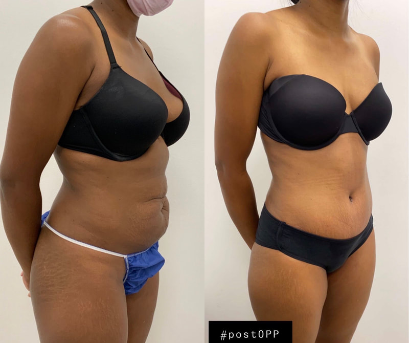 tummy tuck  - before & after 108