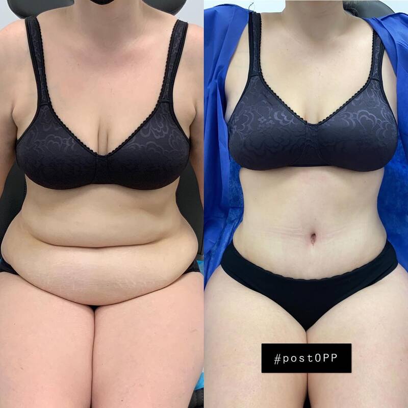tummy tuck  - before & after 121